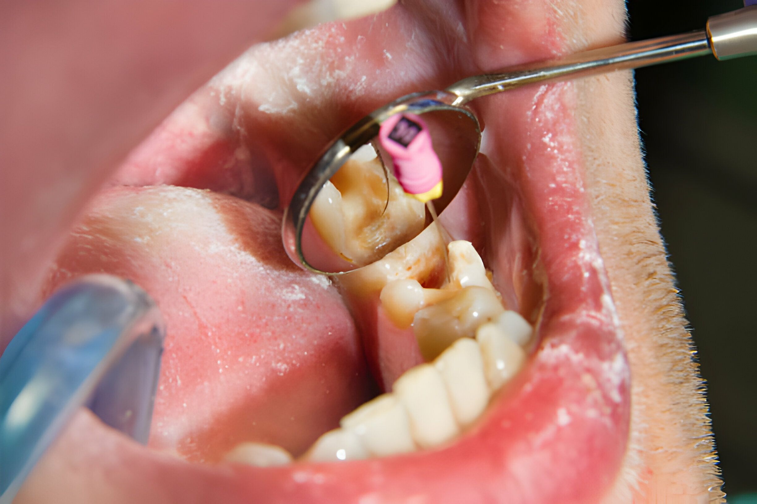 The Different Types of Teeth Extraction: Simple vs. Surgical_3