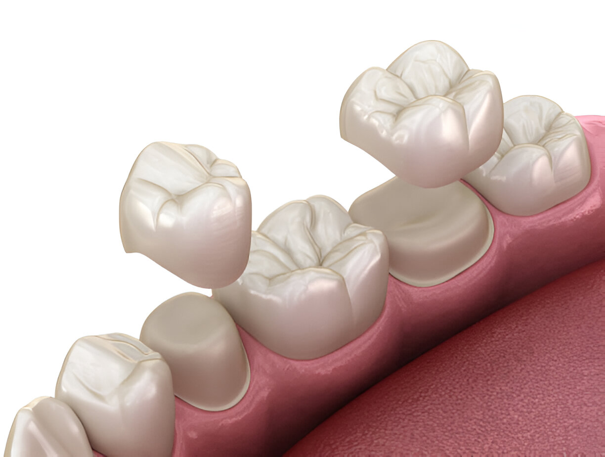 Dental Crowns for Cracked Teeth: A Solution to Save Your Smile_1